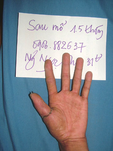 Nối thành công ngón tay cái bị đứt lìa