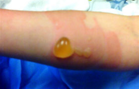 Súng phun tế bào da chữa phỏng