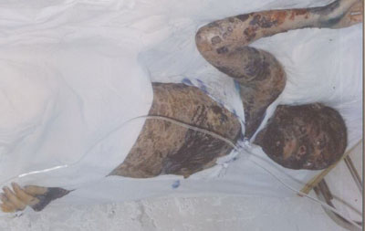 Chị Nguyễn Thị Thùy Nhung đang cần cứu giúp