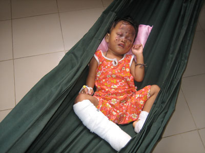 Cảnh giác với tai nạn bỏng