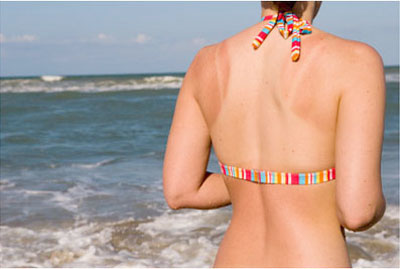 Mẹo chữa cháy nắng cho làn da