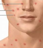 Để phòng tránh bệnh thủy đậu