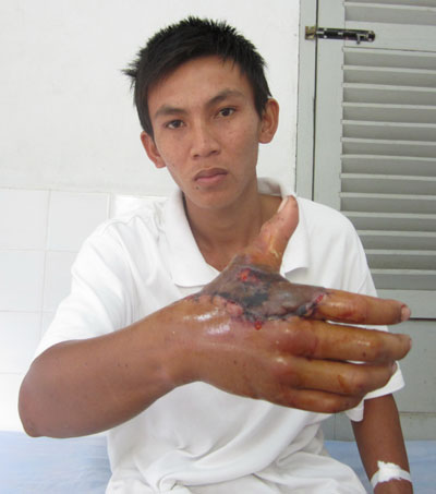 Nối thành công 1 trường hợp đứt lìa ngón cái bàn tay