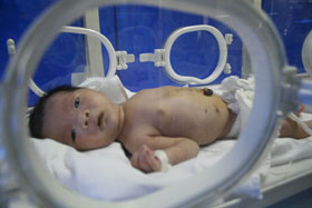 Trẻ sinh mổ nhiều nguy cơ béo phì