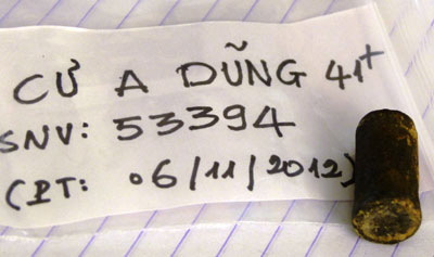 Bệnh nhân Cư A Dũng đã được phẫu thuật