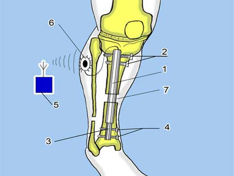 Kéo dài chân tay bằng sử dụng từ trường  