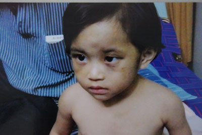 Cháu Trần Thị Như Bảo sau khi bị bạo hành.  