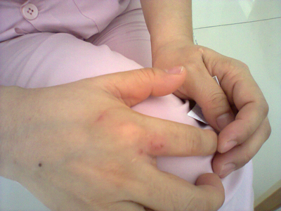 Chị H. vẫn còn vết bầm trên tay vì bị một đối tượng cắn. IMG_ 1597: IMG_5274