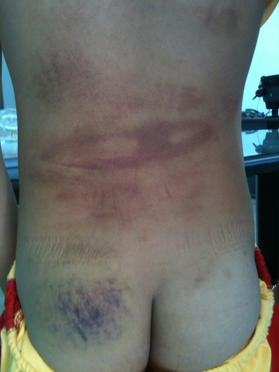 Cháu bé 13 tuổi bị cha đẻ bạo hành