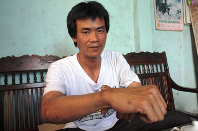 Ngư dân Lê Đình Anh với nhiều vết sẹo chằng chịt trên cánh tay vì những trận đòn.