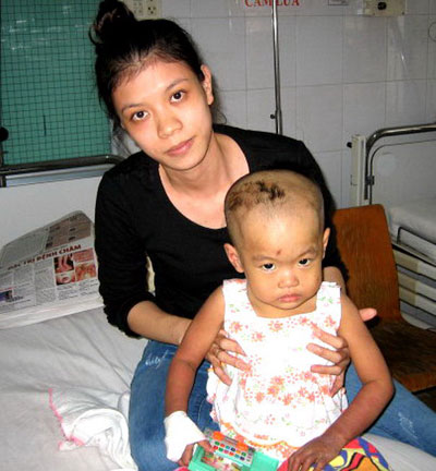 Huyết thực bào: Bệnh hiếm gặp, tỷ lệ tử vong cao