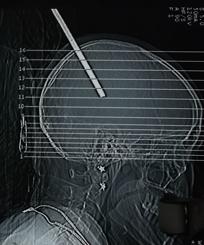 Mổ lấy cây sắt xuyên vào hộp sọ một phụ nữ