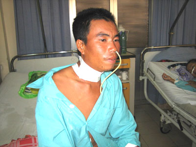 Phẫu thuật cho bệnh nhân bị cá nhái đâm xuyên họng