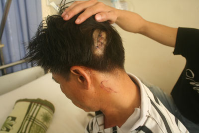 Đến nhà mẹ vợ, bị đánh phải nhập viện