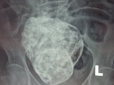 Phát hiện trường hợp "thai đá" ở bà cụ 76 tuổi