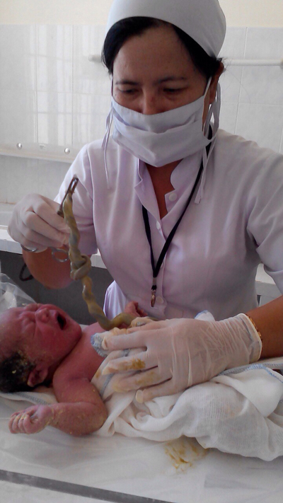 Cứu sống thai nhi có dây rốn thắt nút 1 vòng