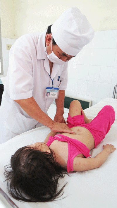 Bệnh thủy đậu đang gia tăng