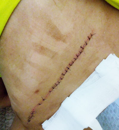 Ninh Hòa: Tái diễn nạn rạch người