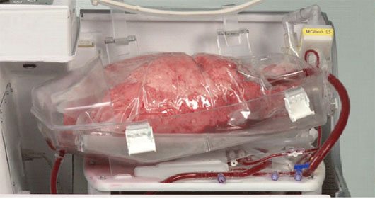Thiết bị duy trì &quot;sự sống&quot; nội tạng bên ngoài cơ thể