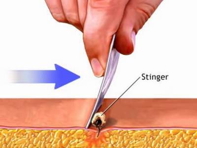 Trị vết ong đốt