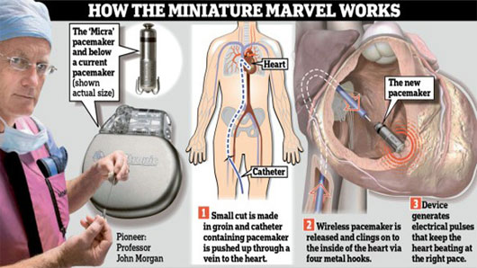 Cấy thành công máy điều hòa nhịp tim không dây