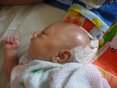 Phẫu thuật thành công khối u lớn trên đầu cho cháu bé 15 ngày tuổi