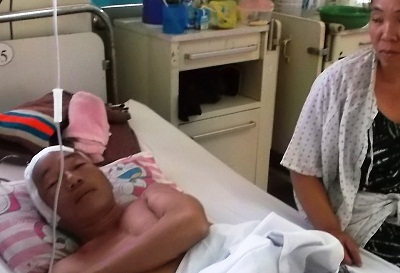 Phẫu thuật thành công trường hợp vỡ túi phình động mạch não