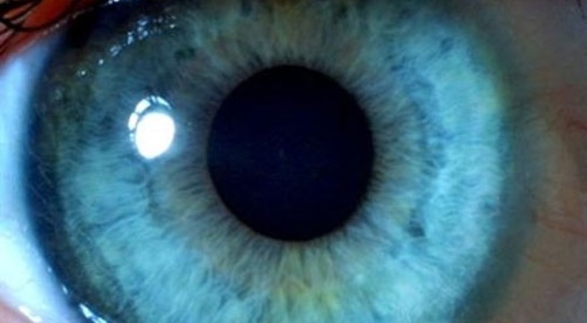 Cấy ghép tế bào biểu mô võng mạc giúp ngăn chặn suy giảm thị lực