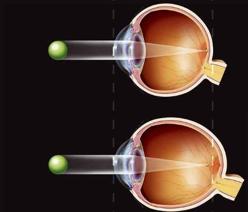Mắt người cận bị (bên dưới) có trục nhãn cầu dài hơn người bình thường (bên trên), khiến ánh sáng tập trung phía trước võng mạc (cận thị), thay vì đúng võng mạc.