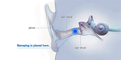 Vị trí đặt máy trợ thính Nanoplug trong tai.