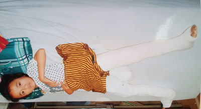 Một học sinh bị gãy 2 chân cần được giúp đỡ