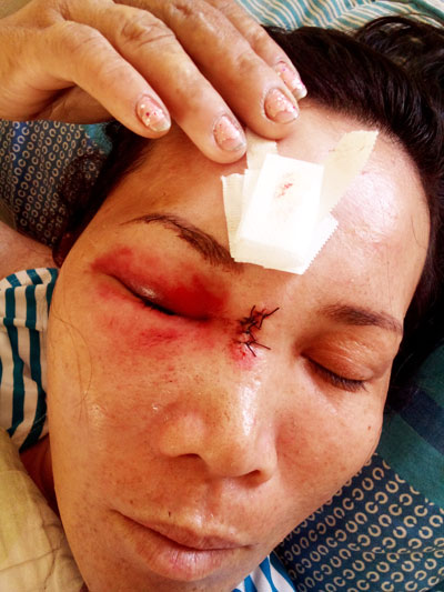 Chị An bị thương tích  sau vụ đánh hội đồng.