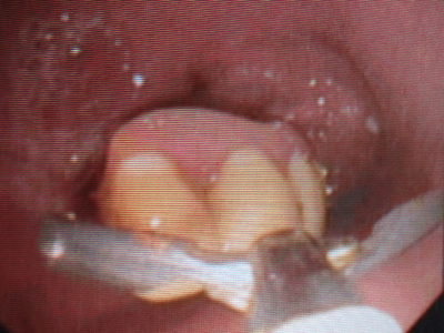 Nội soi phát hiện 4 răng giả trong dạ dày một bệnh nhân