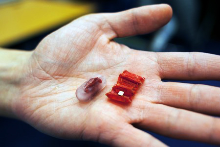 Robot siêu nhỏ giúp loại bỏ những vật thể nuốt nhầm vào bụng