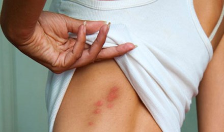 Xử lý nhanh vết côn trùng cắn