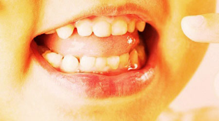 Có thể nuôi cấy răng mới từ tế bào mầm của răng sữa