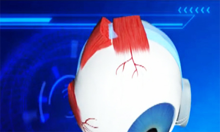 Công nghệ mắt giả giúp người mù khôi phục thị lực