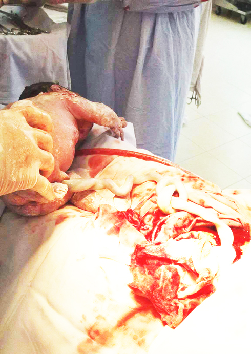 Mổ cứu kịp thời thai nhi có dây rốn bị thắt nút hiếm gặp