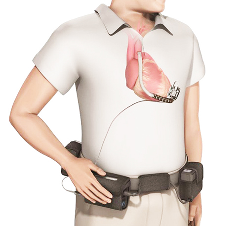  Ở phía ngoài cơ thể, người bệnh sẽ được trang bị một bộ thu phát sóng và một cục pin cầm tay nhỏ