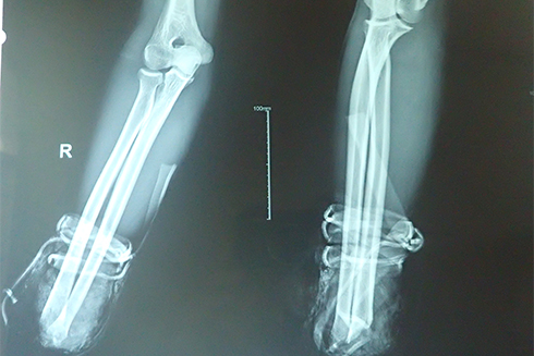 Nối thành công bàn tay bị đứt lìa