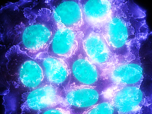 Xác định được các gene đột biến có khả năng gây bệnh ung thư vú