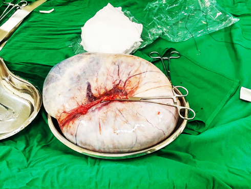 Mổ lấy khối u trong bụng gần 12kg