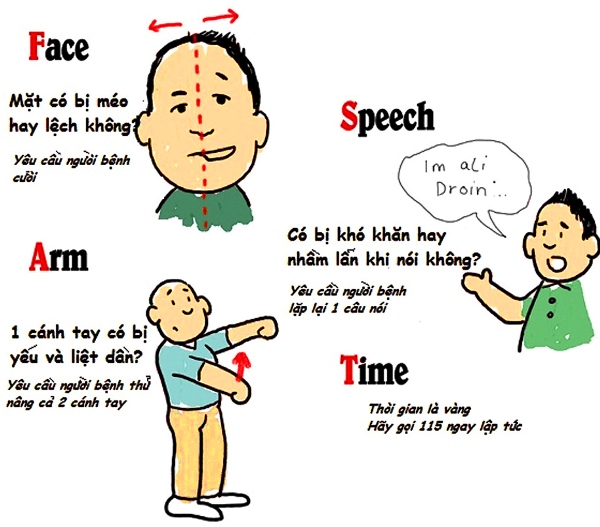 8 thắc mắc phổ biến về đột quỵ bạn nên ghi nhớ