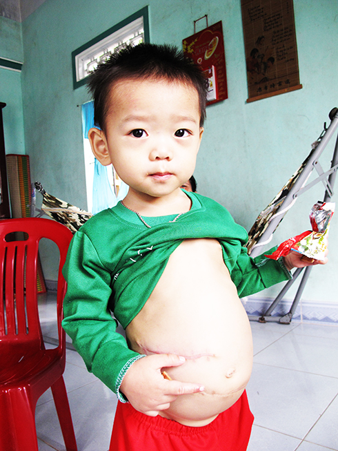 Phan Tuan Kiet with surgical incisions