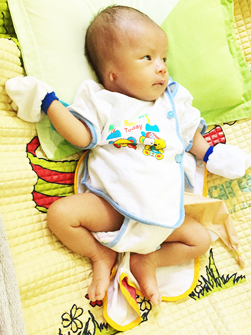 Le Hong Vu, newborn with many serious birth defects.