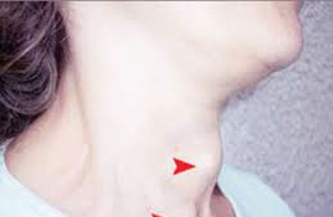 Những trường hợp bị bướu cổ cần điều trị