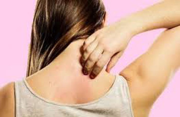 Bệnh ngoài da thường gặp vào mùa hè và cách phòng tránh