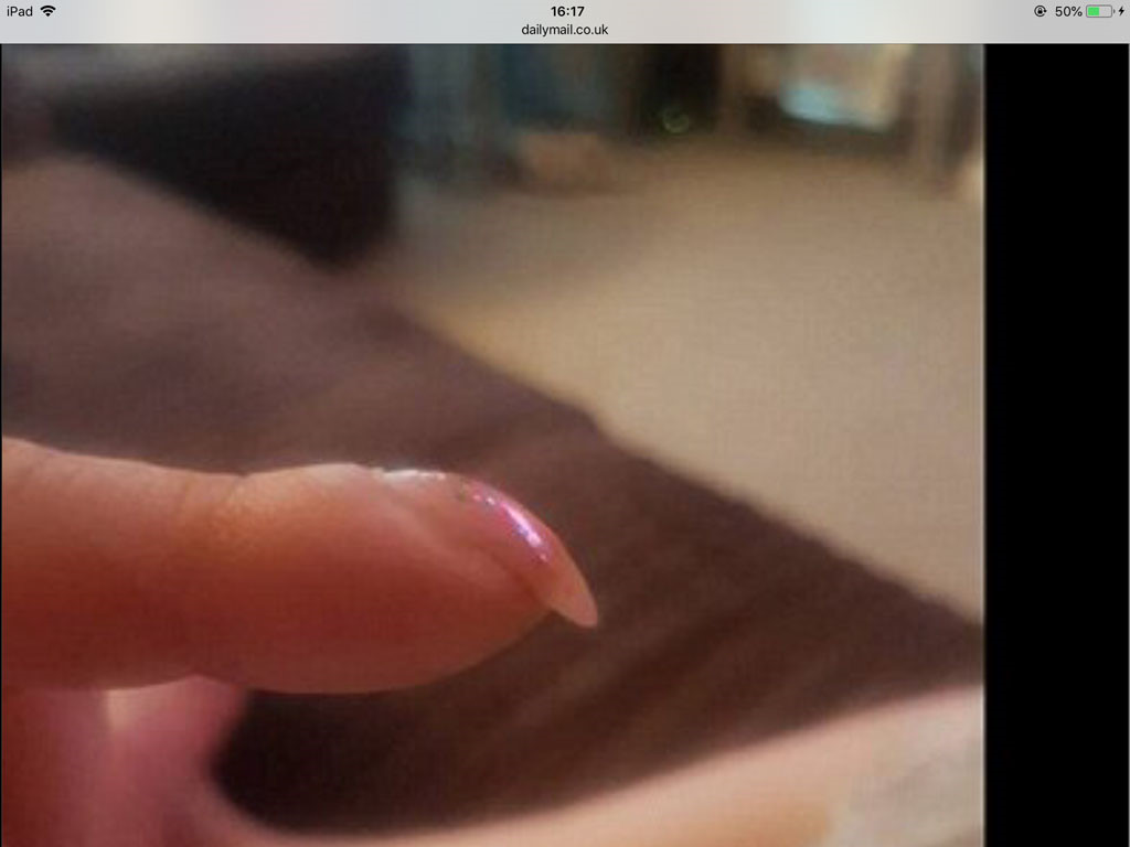 Nếu móng tay cong quặp xuống, đến bệnh viện ngay!