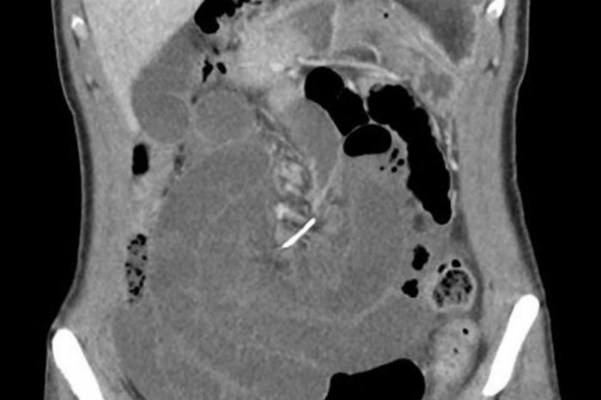 Mảnh kim loại của chiếc niềng răng đâm thủng ruột non người phụ nữ. Ảnh: CNN