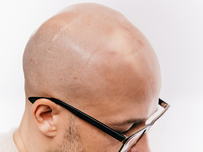 5 dấu hiệu thầm lặng của tắc động mạch